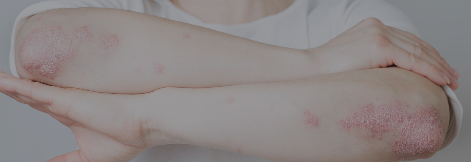 Psoriasis-Things you should know